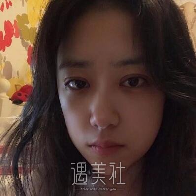 杨小顺双眼皮修复案例|重新恢复自信!