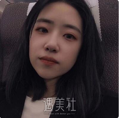 杨小顺双眼皮修复案例|重新恢复自信!