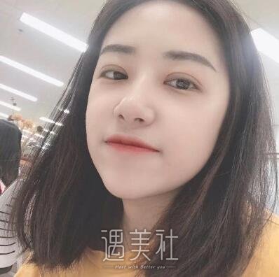 杨小顺双眼皮修复案例|重新恢复自信!