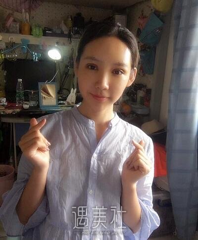 余东做双眼皮修复案例|果人让人羡慕!