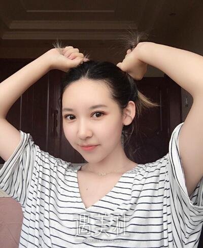 余东做双眼皮修复案例|果人让人羡慕!