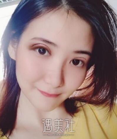 张昕霞双眼皮修复案例|还能恢复以前的果吗?