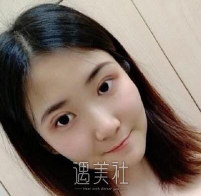 张昕霞双眼皮修复案例|还能恢复以前的果吗?