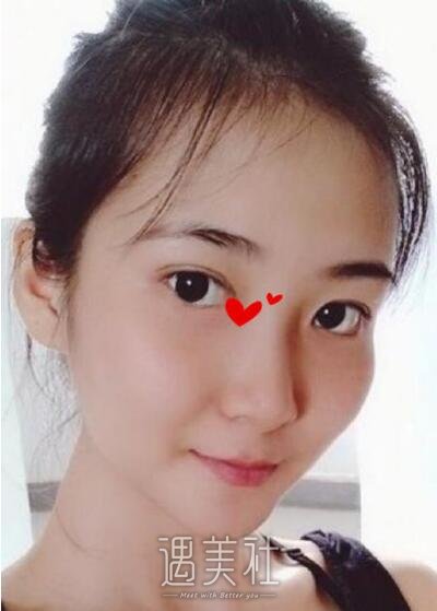 张昕霞双眼皮修复案例|还能恢复以前的果吗?