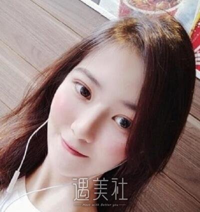 张昕霞双眼皮修复案例|还能恢复以前的果吗?