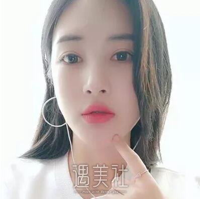 张智勇颧骨内推案例|脸型终得改变!