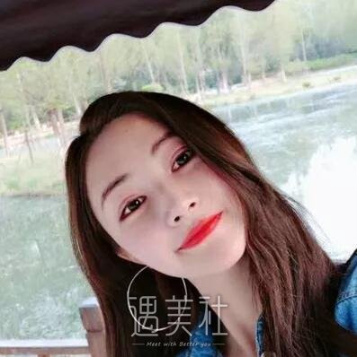 张智勇颧骨内推案例|脸型终得改变!
