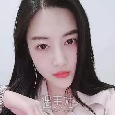 张智勇颧骨内推案例|脸型终得改变!