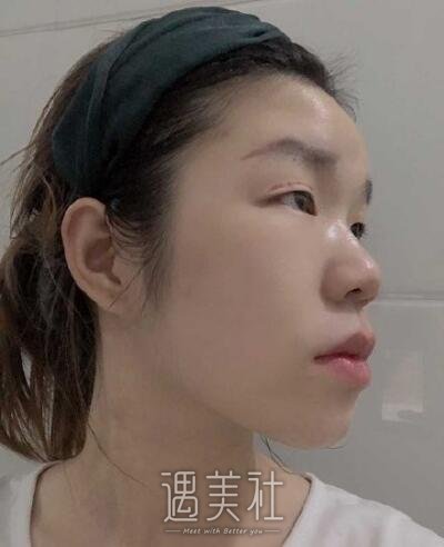 周长兵双眼皮修复案例|精气神瞬间得到改变!