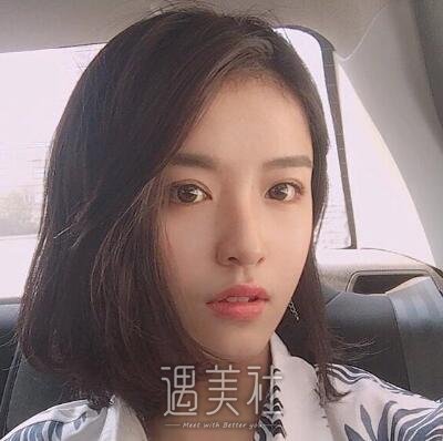周长兵双眼皮修复案例|精气神瞬间得到改变!