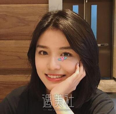 周长兵双眼皮修复案例|精气神瞬间得到改变!