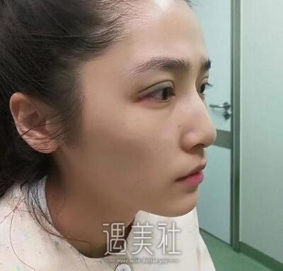 祝联双眼皮修复案例|年轻、漂亮、美美哒!