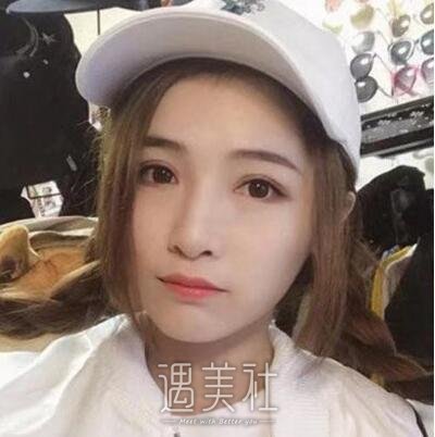 祝联双眼皮修复案例|年轻、漂亮、美美哒!