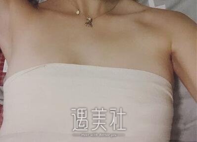 北京润美王明利丰胸案例|眼睛都看直了!