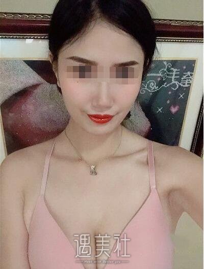 北京润美王明利丰胸案例|眼睛都看直了!