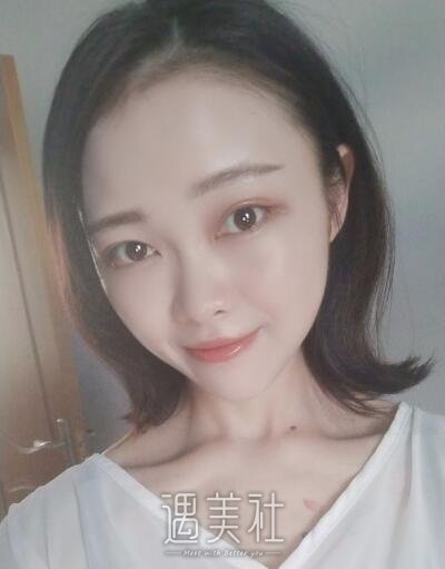 孙玮骏埋线提升案例|果真是惊人!