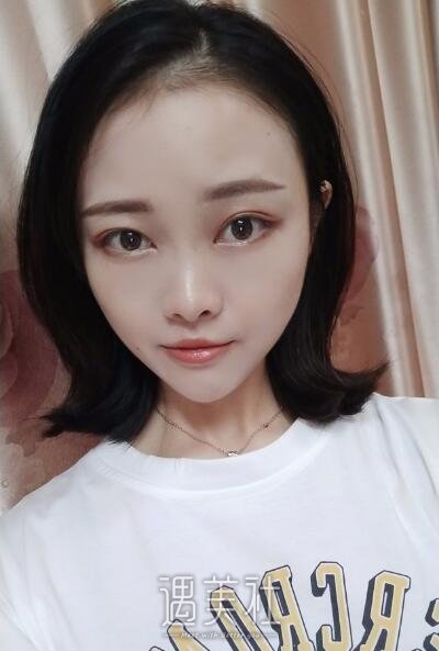 孙玮骏埋线提升案例|果真是惊人!