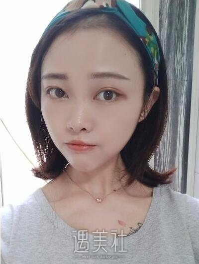 孙玮骏埋线提升案例|果真是惊人!