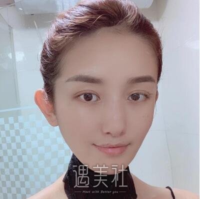 韩勋双眼皮案例|男神终于和我在一起了!