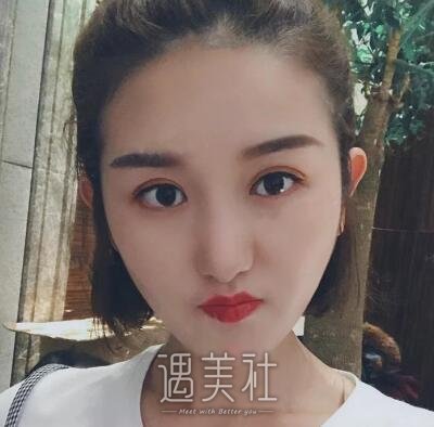 韩勋双眼皮案例|男神终于和我在一起了!