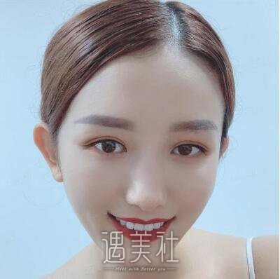 韩勋双眼皮案例|男神终于和我在一起了!