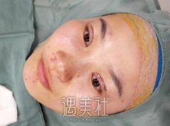 中日友好齐彦文双眼皮案例展示|果很理想! width=
