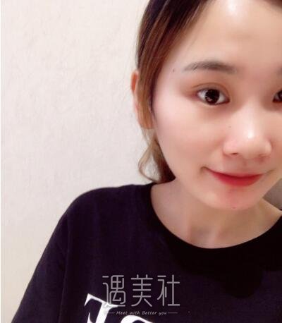 中日友好齐彦文双眼皮案例展示|果很理想!