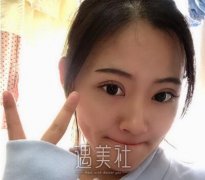 中日友好高占巍双眼皮案例|走出了黑暗的世界! width=