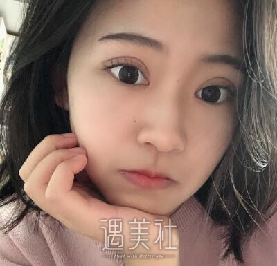 中日友好高占巍双眼皮案例|走出了黑暗的世界!