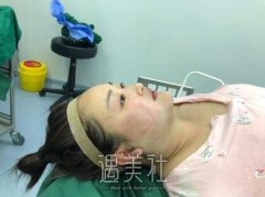 中日友好付小卒注射瘦脸案例|瘦脸果很明X! width=