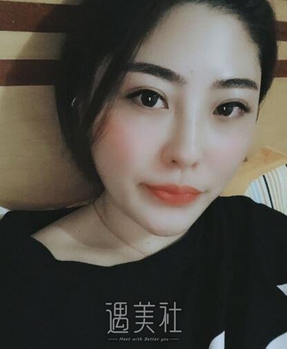 中日友好胡晓根腋臭去除案例|终于有人接近我了!