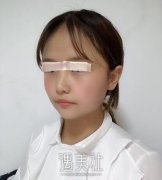 中日友好胡晓根双眼皮案例|焕然一新的感觉! width=