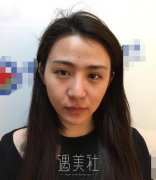 北京知音白志鹏隆鼻案例|还真是看颜值的世界! width=