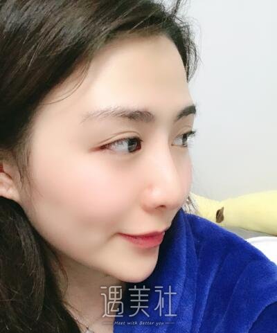 北京凯润婷白志鹏隆鼻案例|还真是看颜值的世界!