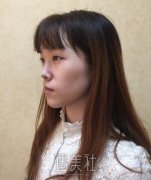 北京美莱宋长绪玻尿酸隆鼻案例｜玻尿酸打鼻子见快！ width=