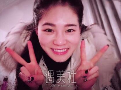 北京京韩乔爱军双眼皮案例|渐渐拥有了自信!