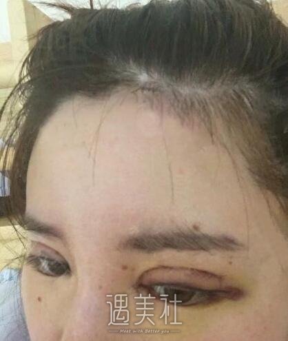北京京韩乔爱军双眼皮案例|渐渐拥有了自信!