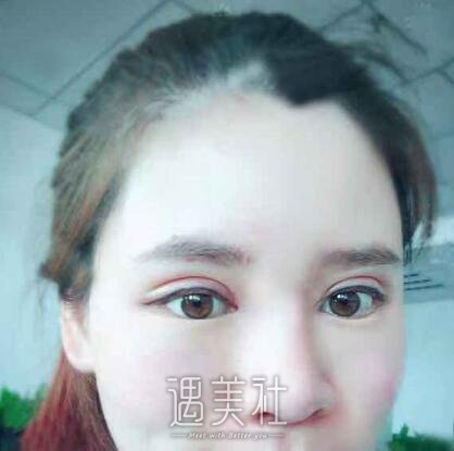 北京京韩乔爱军双眼皮案例|渐渐拥有了自信!