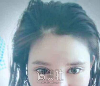 北京京韩乔爱军双眼皮案例|渐渐拥有了自信!
