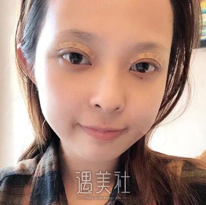海医悦美林勇双眼皮案例|果真的很不错!