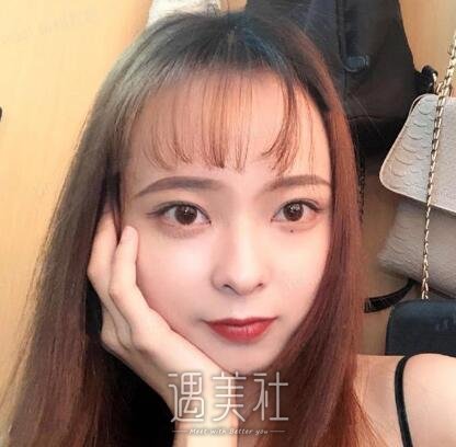海医悦美林勇双眼皮案例|果真的很不错!