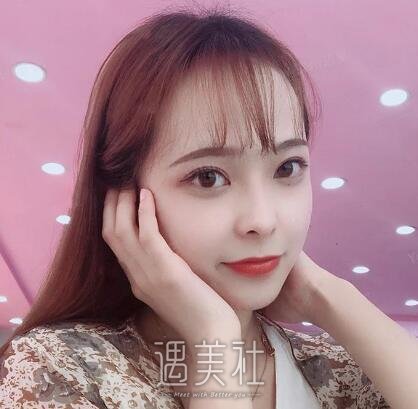 海医悦美林勇双眼皮案例|果真的很不错!