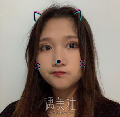 北京美莱杜园园双眼皮案例|人生出现了变化!