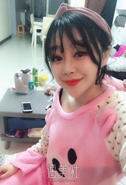 北京美莱曹士华面部脂肪填充案例|看起来更加丰润了!