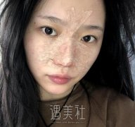 北京美莱欧阳春隆鼻案例|成功想要状态! width=