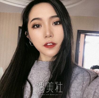 北京美莱欧阳春隆鼻案例|成功想要状态!