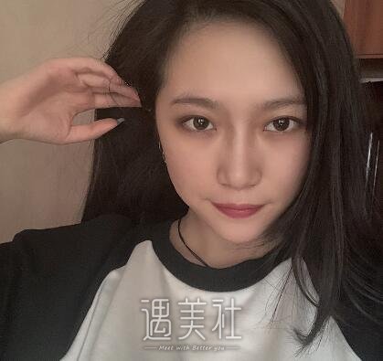 北京美莱欧阳春隆鼻案例|成功想要状态!