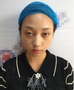 北京美莱欧阳春鼻修复案例，重新拾取了信心! width=