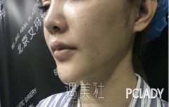 如何判断自己有没有被打奥美定呢？ width=