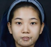 徐州二院李雪阳双眼皮案例 width=